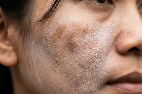 Kulit wajah tampak kusam, bintik flek terlihat jelas, dan residu krim putih menggumpal di pori