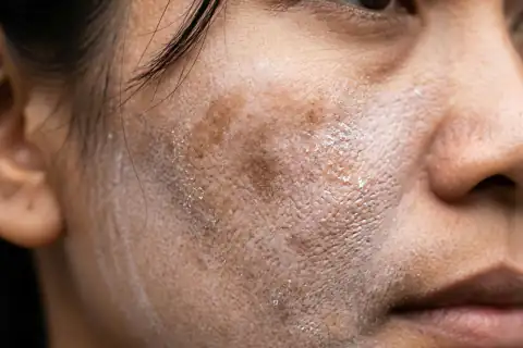 Kondisi kulit wajah tampak kusam, noda hitam terlihat jelas, disertai kemerahan dan bruntusan