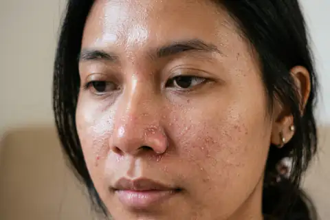 Wajah tampak kemerahan dan muncul bruntusan halus karena memakai krim malam yang terlalu pekat