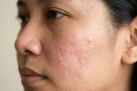 Kondisi kulit kilap berminyak dengan kemerahan dan bruntusan sebelum perawatan