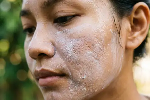 Kulit wajah bruntusan dan kemerahan akibat memakai krim dan sunscreen yang terlalu berat