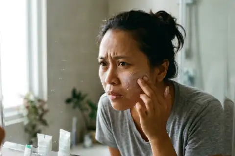 Krim pagi retak dan menggumpal di area garis senyum yang kering