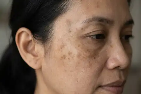 Wajah tampak belang abu-abu akibat krim pemutih instan warna putih kapur